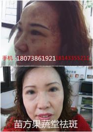 雀斑液 去雀斑药水 点斑水 苗方果蔬堂