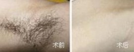 广州OPT美容仪器厂OPT冰点无痛快速脱毛直销美导免费指导